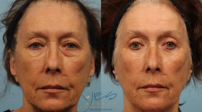 Before & After Upper Eyelid Blepharoplasty Case 287 Front View in Vancouver, BC