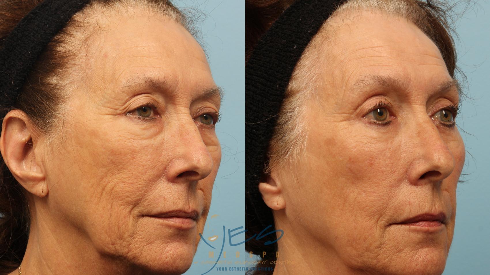 Before & After Upper Eyelid Blepharoplasty Case 287 Right Oblique View in Vancouver, BC