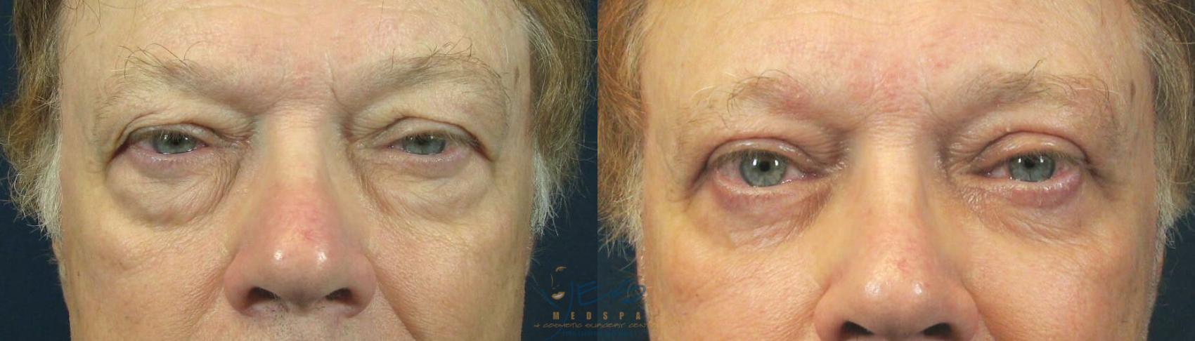 Before & After Upper & Lower Blepharoplasty Case 92 View #1 View in Vancouver, BC