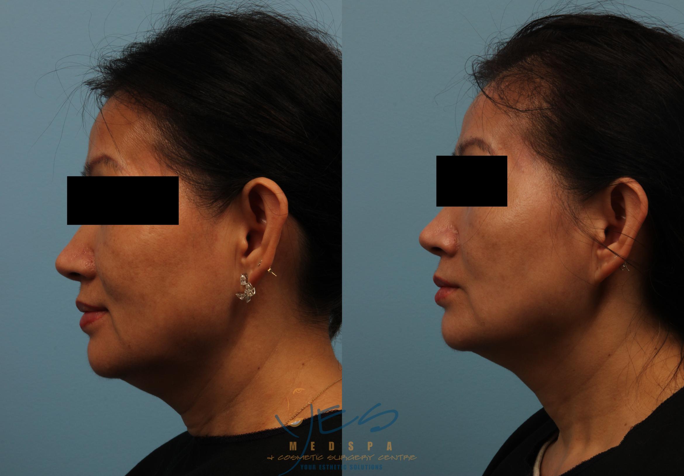 Venus Legacy Before & After Photos Patient 241 Langley