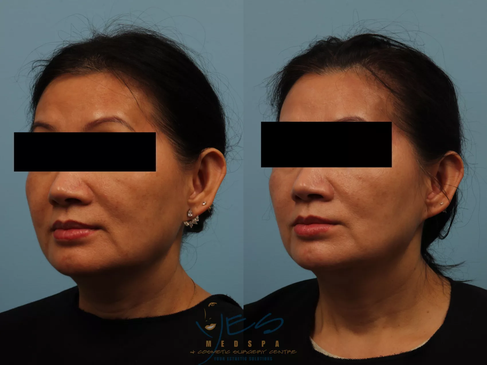 Facial Slimming Vancouver, BC  Non Surgical Jawline Treatment