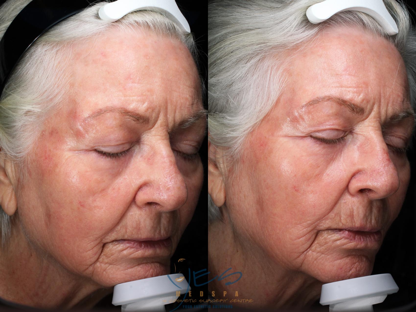 Wrinkles Treatments in Vancouver, BC